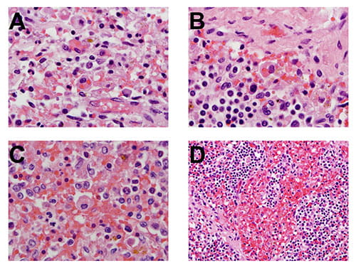 Representative examples of hemophagocytosis characterized by macrophages with engulfed red blood cells in lymph node (A and B) and spleen (C and D) in patients with macrophage activation syndrome. 